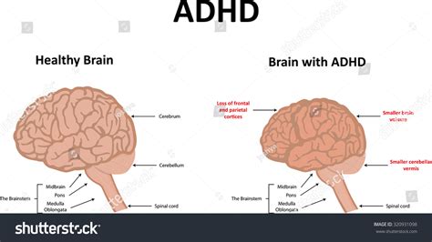 1927 Adhd Brain Stock Illustrations Images And Vectors Shutterstock