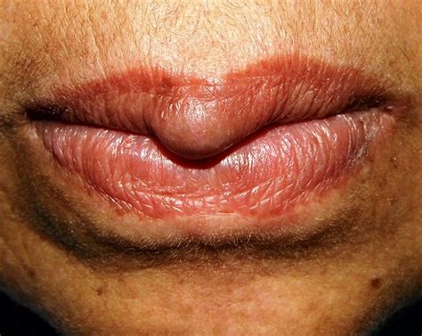 white spots on lips causes pictures small on lower upper inside lip american celiac
