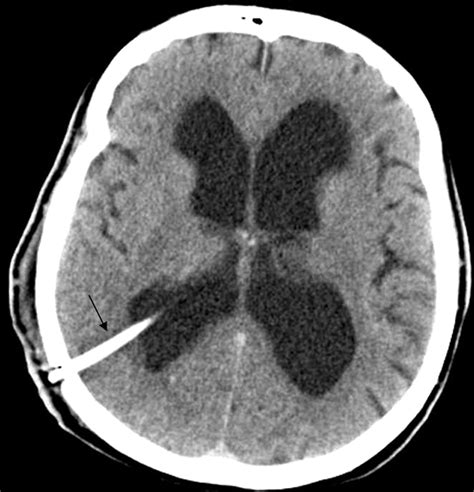 Memory Loss With Enlarged Brain Ventricles Bmj Case Reports