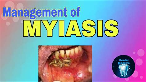 Myiasis Infection From Flies Management Dental Maestro Youtube