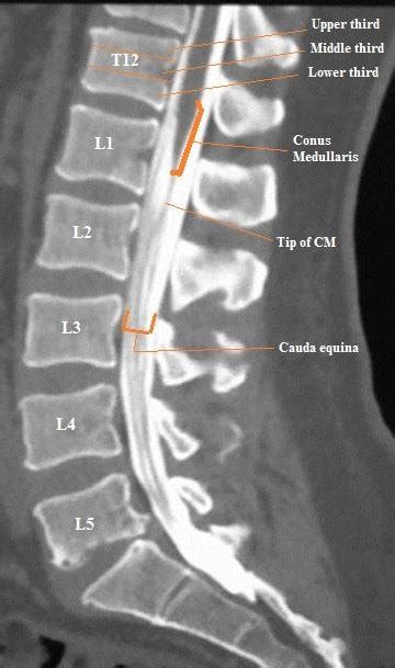Ct Scan Of Lumbar Spine E Anatomy Images And Photos Finder