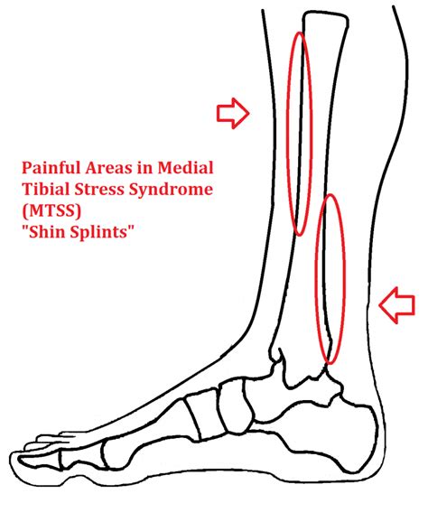 Shin Splints Medial Tibial Stress Syndrome Ankle Foot My Xxx Hot Girl