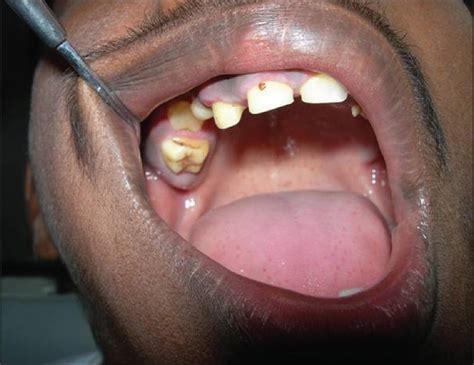 Intraoral View Of Patient Showing Retained Deciduous Molar And