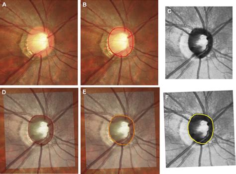 Optic Disc Margin Anatomic Features In Myopic Eyes With Glaucoma With