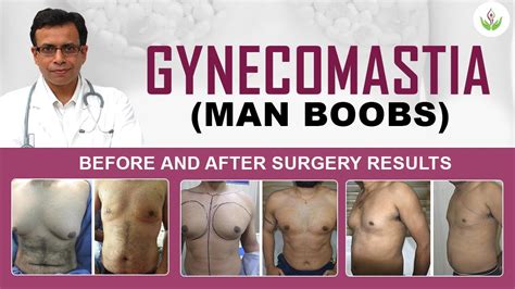 Gynecomastia Man Boobs Before And After Surgery Results Photos Care Well Medical Centre