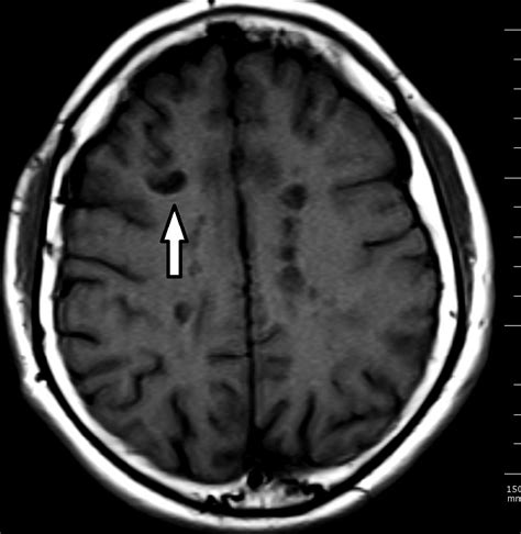 Mri Shows Hole In Brain A Pictures Of Hole 2018