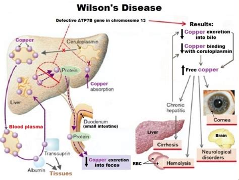 Wilsons Disease Dr Thind