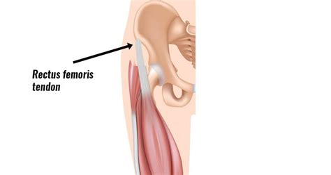 Rectus Femoris Tendinopathy