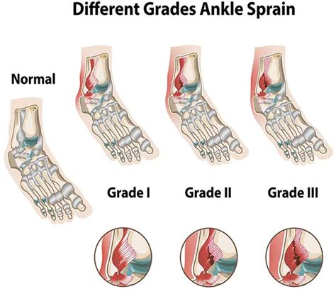 Sprain Vs Strain Anatomical Comparison As Medical Foot Injury Outline
