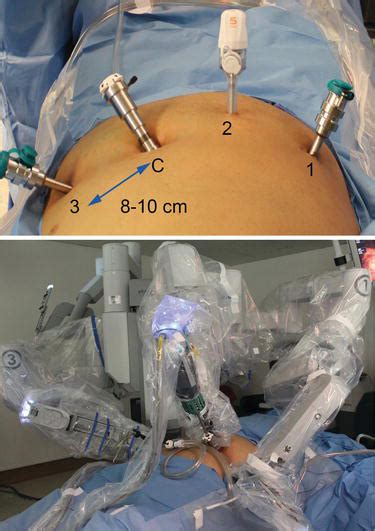 Robotic Approach To Cholecystectomy Intechopen