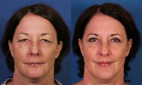 Cosmetic Upper Eyelid Enhancement Surgery