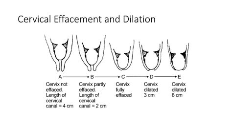 3 Cm Dilated Cervix