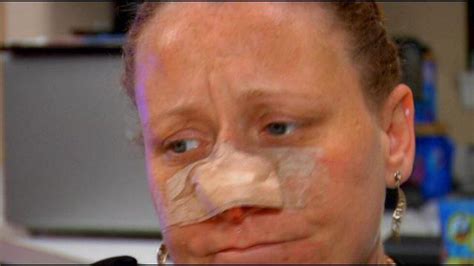Woman Speaks Out After Nose Bitten Off In Violent Attack