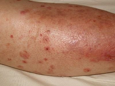 Can A Rash Be Caused By Diabetes January