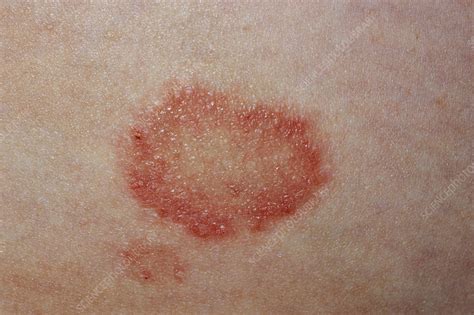 Ringworm Stock Image M2700263 Science Photo Library