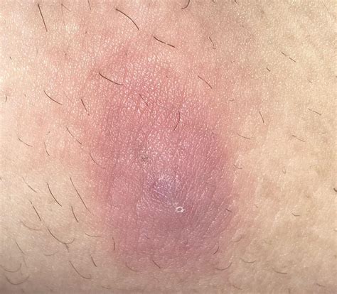 What Could This Be Its A Bump On My Inner Thigh Thats Warm When You
