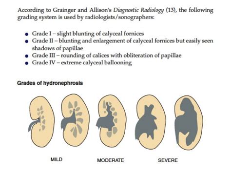 Hydronephrosis Grading Kidneys Ultrasound Sonography