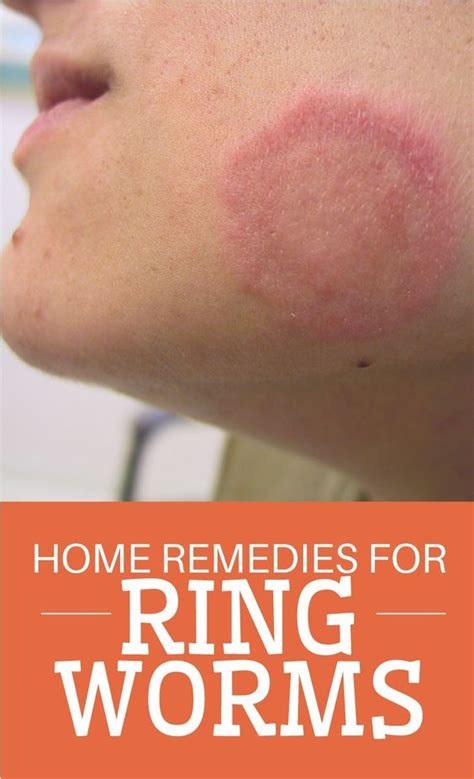 23 Beneficial Home Remedies For Ringworm Health And Diy Ideas