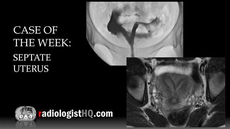 Case Of The Week Septate Uterus MRI YouTube