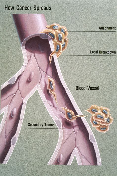 Carcinoid tumors and carcinomas are staged differently. Metastasis - Wikiwand