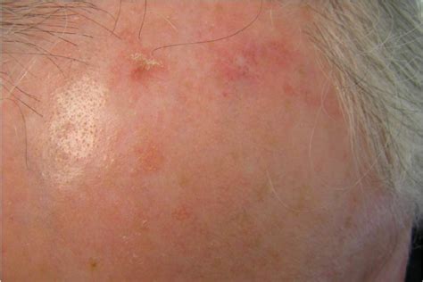 Actinic Keratosis Treatment