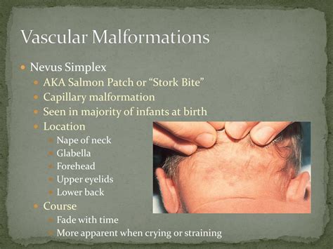 Ppt Hemangiomas And Vascular Malformations Powerpoint Presentation