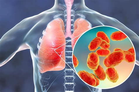 Bacterial Pneumonia Associated With Increased Risk For Future Mace