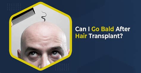 Can I Go Bald After Hair Transplant Marvelous Aesthetics