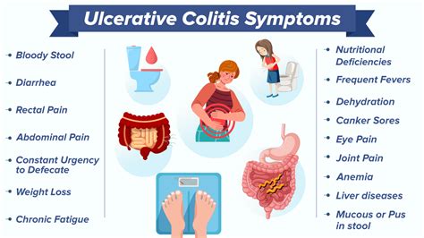 What Are The Warning Signs Of Ulcerative Colitis Ulcertalk Hot Sex