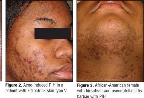 Pdf Postinflammatory Hyperpigmentation A Review Of The Epidemiology