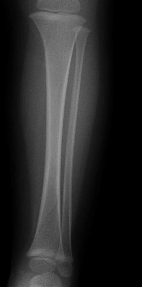 Plain X Ray Ap View Of Toddlers Fracture A Minimally Displaced Or