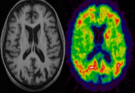 Mri Pet Scanner Will Enable New Insights Into Dementia Imperial News