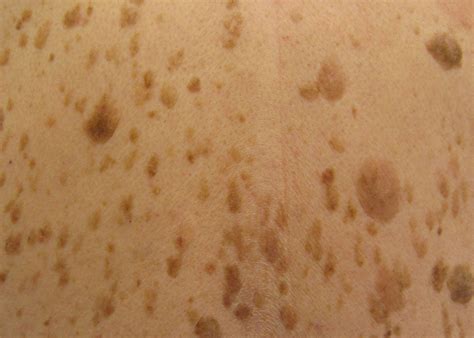 Seborrheic Keratoses On Back Causes And Treatments Exposed Skin