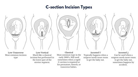 C Section Incision Types Learn More About Special Scars