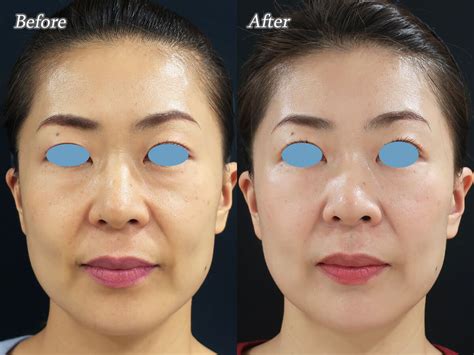 ヒアルロン酸注射によるフェイスリフト 美容皮膚科女医のブログ