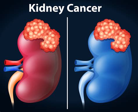 Two Diagram Of Kidney Cancer 303344 Vector Art At Vecteezy