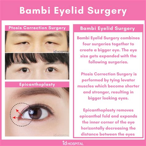 Bambi Eyelid surgery at ID Hospital in 2021 | Eyelid surgery, Plastic surgery, Surgery