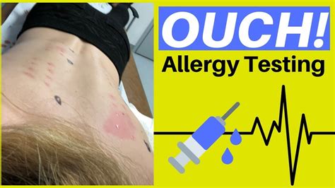 My Allergy Test Results Youtube