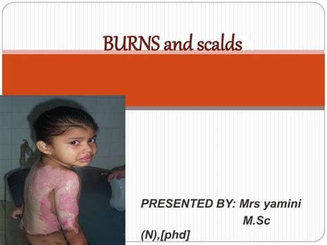 Burns And Scalds Ppt