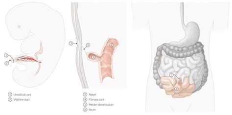 Diverticula And Volvulus Of Sigmoid Colon 13 Flashcards Quizlet