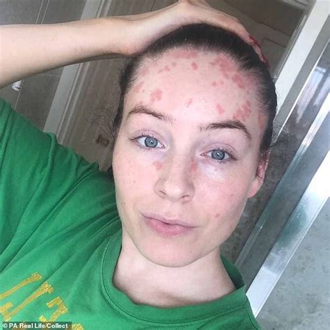 Woman With Red Raw Skin Patches Makes Remarkable Transformation