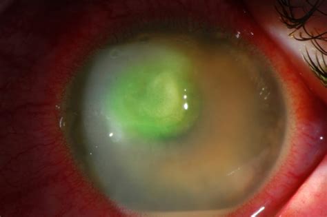 Fungal Ulcer Eye