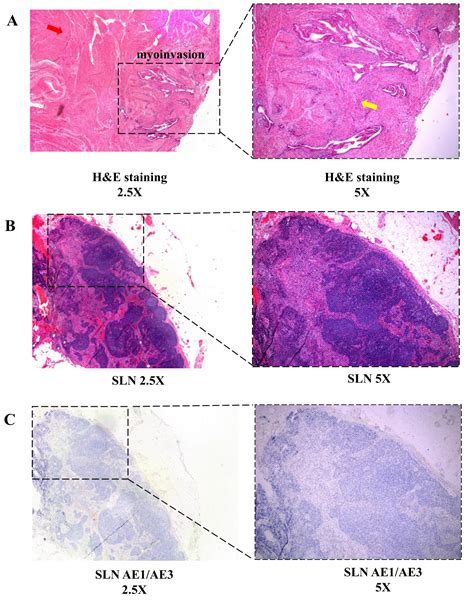 Sentinel Lymph Node Mapping And Biopsy For Endometrial Cancer At Early