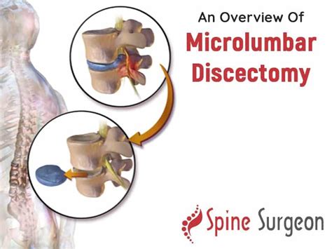 Microdiscectomy Scar