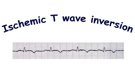 Freestyle Ecg Showing T Wave Inversion