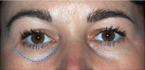 Tear Troughs With Teosyal Redensity Ii Visage Aesthetics Training
