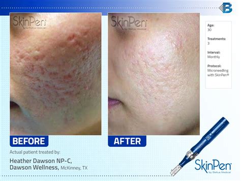 Acne Scars Before And After Dermaroller Shearlingwomenbestquality
