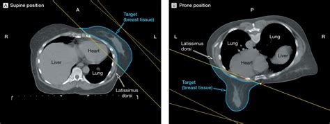 Prone Vs Supine Positioning For Breast Cancer Radiotherapy Breast