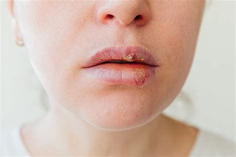 Viral Infection On Lips Treatment Lipstutorial Org