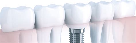 Single Dental Implant Replacement Of Teeth Single Dental Implant